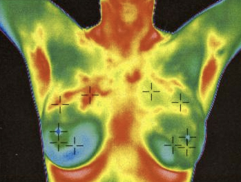 Medical Thermal Imaging Body & Breast Screening